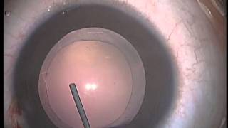 Pediatric Cataract Surgery Lens Aspiration PCCC Anterior Vitrectomy and IOL Implanation [upl. by Aimee]