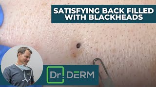 Satisfying Back Filled with Blackheads  Dr Derm [upl. by Stiegler]