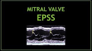 How to measure the EPSS Systolic function  Echocardiography [upl. by Ateikan359]