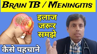 Brain TB  Tubercular Meningitis  TBM  Tuberculoma  Dr Sanjay chest specialist [upl. by Xirtaeb]