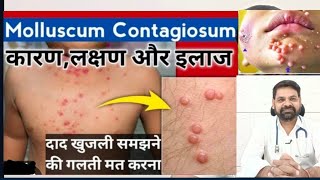 Molluscum contagiosum in hindi  Molluscum contagiosum treatment  Molluscum contagiosum [upl. by Petersen692]