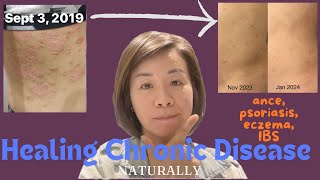 Steps to Clear Posriasis Eczema Acne IBS Migraine Obesity  healingpsoriasis alicefitca [upl. by Hitchcock]