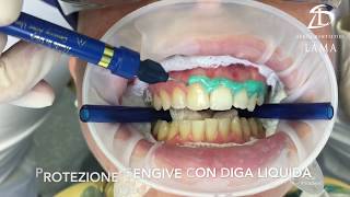 Studi Dentistici Lama  Sbiancamento Dentale alla Poltrona [upl. by Nosro212]