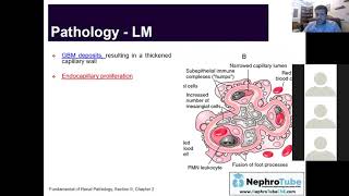 Membranoproliferative Glomerulonephritis Arabic Version [upl. by Itch]