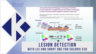 Lesion detection with LCI and Short DBE for colonic ESD with Professor Hironori Yamamoto [upl. by Maynord]