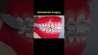 Ortho Treatment open bite العلاج التقويم للعظه المفتوحه 🎖️👌 [upl. by Fruma35]