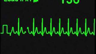 Normal Pediatric ECG  ECG Simulator  Arrhythmia Simulator [upl. by Lev]