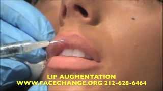 Lip Augmentation Treatment [upl. by Nirak]