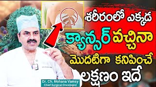 ఒంట్లో కాన్సర్ కణాలు ఉంటె కనిపించే సూచనలు  DrMohan Vamsi About Cancer  Sumantv health Care [upl. by Eehsar514]