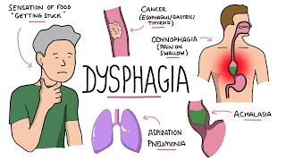 Dysphagia  Oropharyngeal amp Esophageal Dysphagia CausesDifferential Diagnosis Signs Treatment [upl. by Novak]