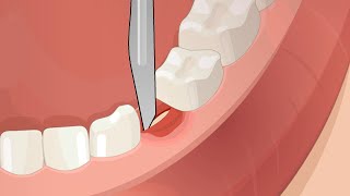 Dental Surgery Operation Root Canal Implant Anesthesia [upl. by Shantee]