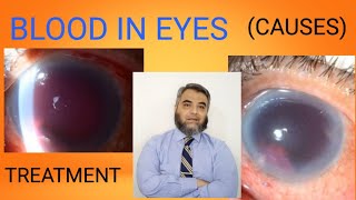 HYPHEMABLOOD ACCUMULATION IN EYES [upl. by Lanette]