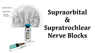 Anesthetic Blocking of the Supraorbital and Supratrochlear Nerves [upl. by Lyrad272]