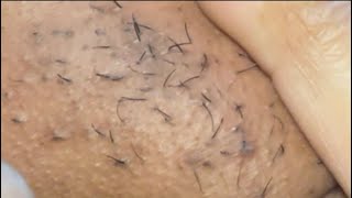 INGROWN HAIR REMOVAL 22  2022 [upl. by Cirederf]