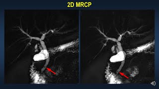 CholedocholithiasisMRCP diagnosis and pitfalls [upl. by Nahttam]