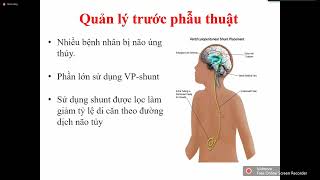 MEDULLOBLASTOMA  BS Nguyễn Việt Thắng [upl. by Skipton]