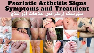 Psoriatic Arthritis  Symptoms and Treatment psoriaticarthritis autoimmunedisease [upl. by Nede778]