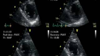 DOBUTAMINE ECHOCARDIOGRAM  ECHOCARDIOGRAPHIE DE STRESS NORMAL [upl. by Eilram]