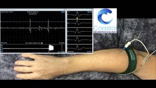 Needle EMG demonstration [upl. by Rahel]