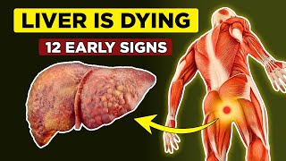 LIVER is DYING 12 Weird Signs of Liver Damage  Healthify [upl. by Oys]