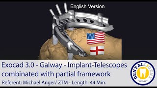 2021Exocad 30  TUTORIAL PREVIEW  Galway ImplantTelescopes combinated with partial framework [upl. by Kcirre438]