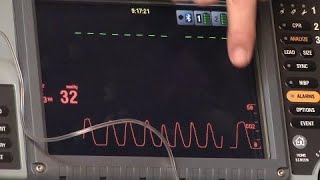 Waveform Capnography [upl. by Harry]