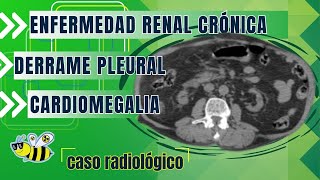 Enfermedad Renal Crónica Cardiomegalia Derrame Pleural [upl. by Kostival294]