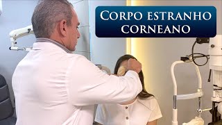 Corpo Estranho Corneano [upl. by Harwin]