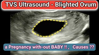 TVS Ultrasound  Blighted Ovum  Miscarriage [upl. by Ennirroc]