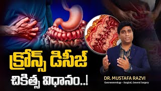 Treatment Options for Crohns disease telugu  క్రోన్స్ వ్యాధి  Gut health  Stomach  Dr Mustafa [upl. by Chandra818]