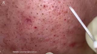 Big Cystic Acne Blackheads Extraction Blackheads amp Milia Whiteheads Removal Pimple Popping [upl. by Adilem]