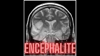 ENCEPHALITE [upl. by Edyth834]