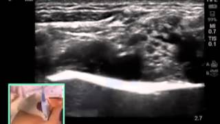 How to Ultrasound Guided Supraclavicular Brachial Plexus Nerve Block [upl. by Aldarcy]