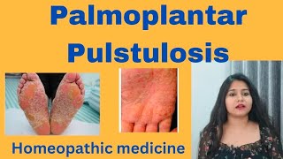 Palmoplantar Pulstulosis treatment  Palmoplantar Pulstulosis symptomscauses amp homeopathic medicine [upl. by Tichon110]