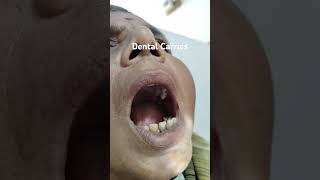 Dental abscess  Dental Carries [upl. by Aihpos818]