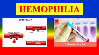 HEMOPHILIA definition  types  Pathophysiology clinical manifestations management [upl. by Ohcirej]