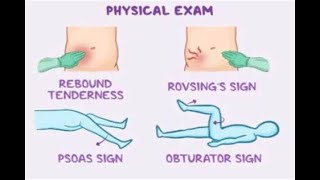 Why would a Retrocaecal Appendicitis cause Pain when the Thigh is Lifted Psoas and Obturator Sign [upl. by Digirb]