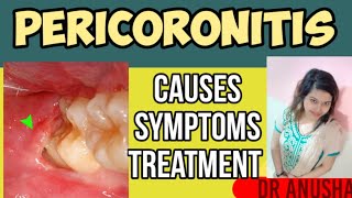 Pericoronitis Causes Symptom amp Treatment II Akal daad dard k karan amp illaj II [upl. by Kolb]