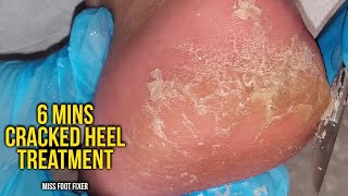 Remove Cracked Heels  So satisfying 6 mins Cracked heel treatment by miss foot fixer [upl. by Gurolinick]