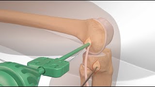 Réparation du ligament antérolatéral du genou  Chirurgie ligamentoplastie  Dr Simon Tournemine [upl. by Allistir]