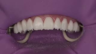 Clinical Tip on veneer temporization [upl. by Amasa]