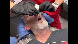 CRNA Anesthesia Nasal Intubation POV Dental Office [upl. by Huan421]