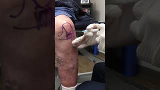 Anterior Knee Injection  Elite Sports Medicine  Lethbridge [upl. by Jacintha869]