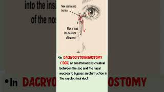 DCR  Dacrocystorhinostomy ophthalmology [upl. by Laroy]