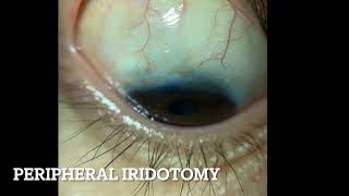 Peripheral Iridotomy [upl. by Yeaton]