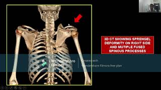 CTBUZZ2023Sourav Routray Radiological Manifestations of Klippel Feil Syndrome [upl. by Maurise959]