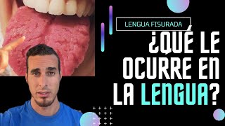 ¿Por qué tiene la LENGUA AGRIETADA  Causas de la lengua FISURADA o ESCROTAL shorts [upl. by Busiek]