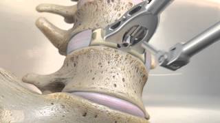 STALIF M™ MIDLINE II Surgical Technique Animation  Anterior Lumbar Interbody Fusion [upl. by Ahsatniuq]