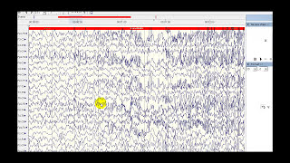 Brain waves Alpha Beta Theta Delta and EEG [upl. by Carri846]