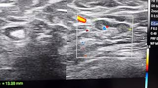 Axillary lymph nodes on ultrasound [upl. by Eelannej630]